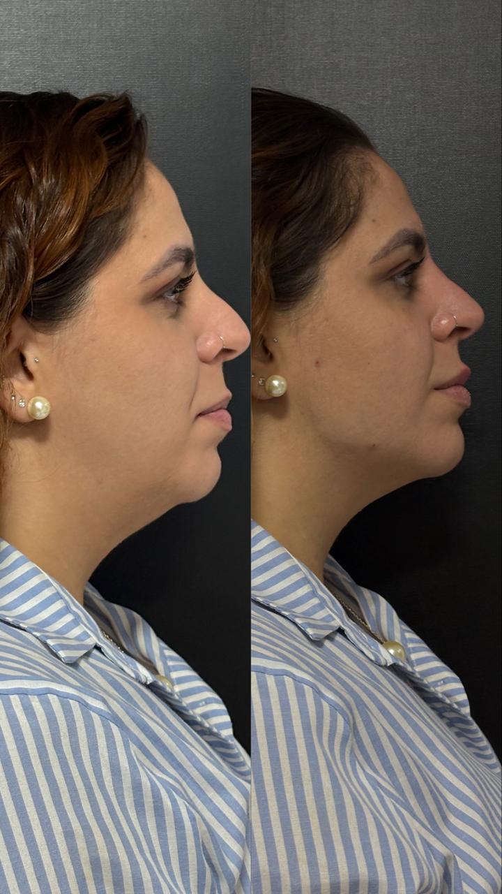 Antes e depois de contorno mandibular com preenchimento de ácido hialurônico