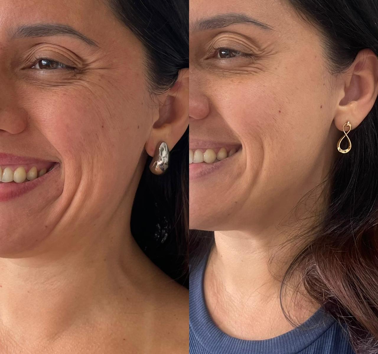 Antes e depois de tratamento para flacidez facial