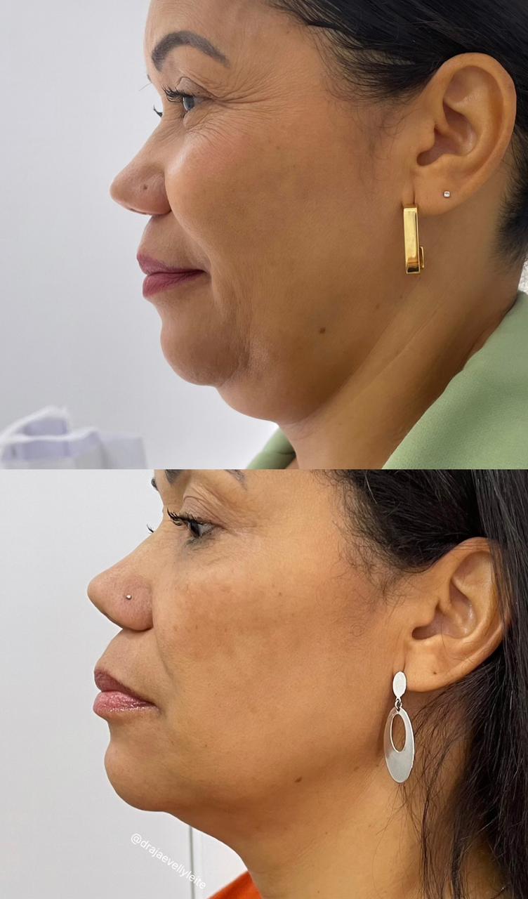 Antes e depois de tratamento para papada