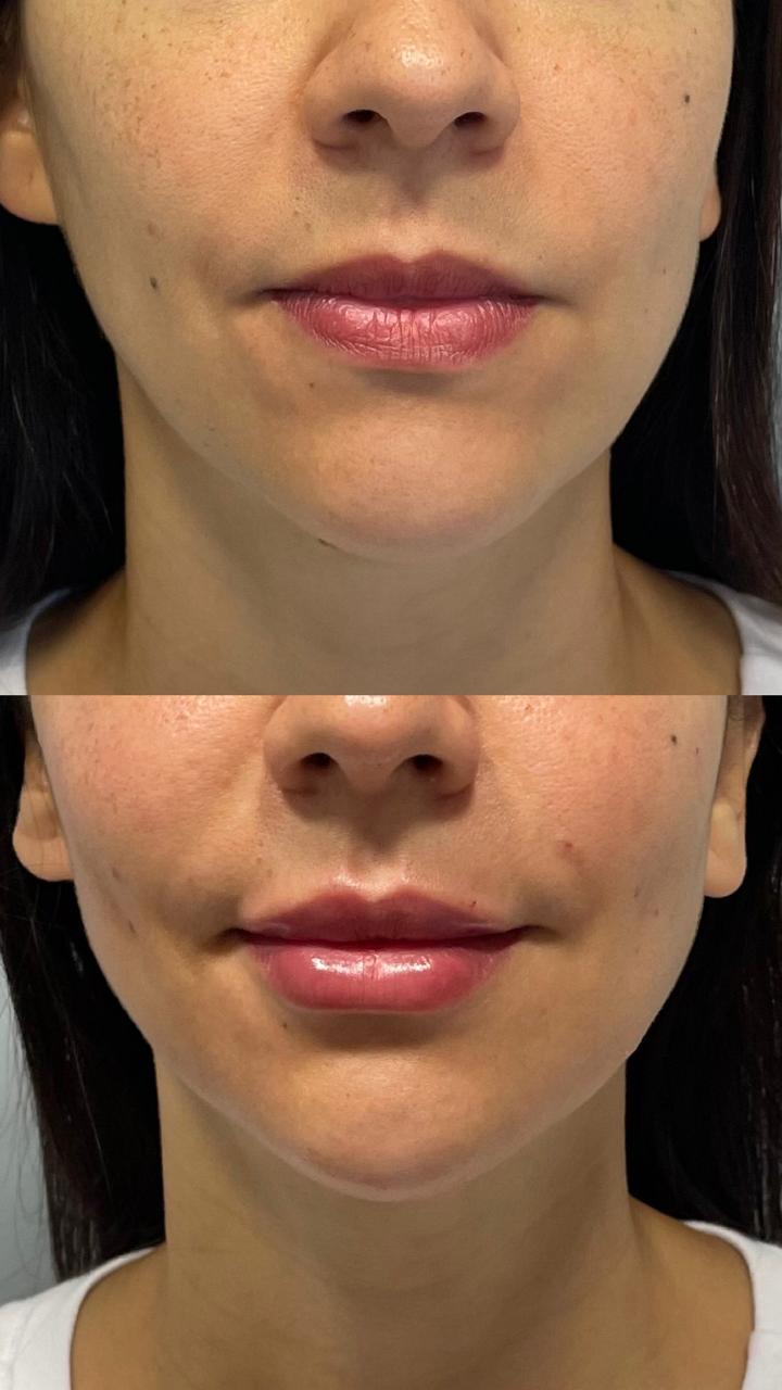 Antes e depois de preenchimento labial na Vellys Estética Avançada