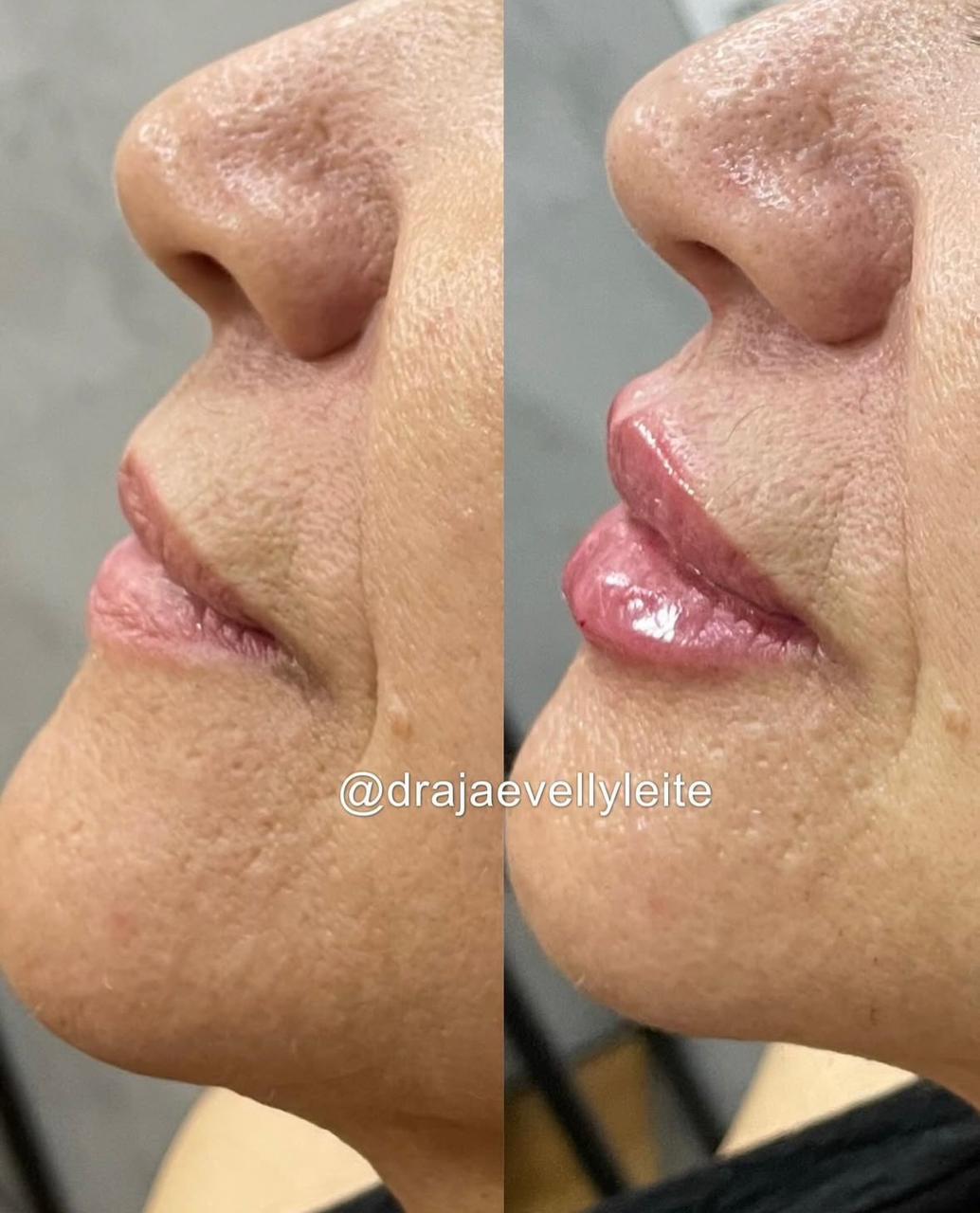 Resultado de preenchimento labial com ácido hialurônico