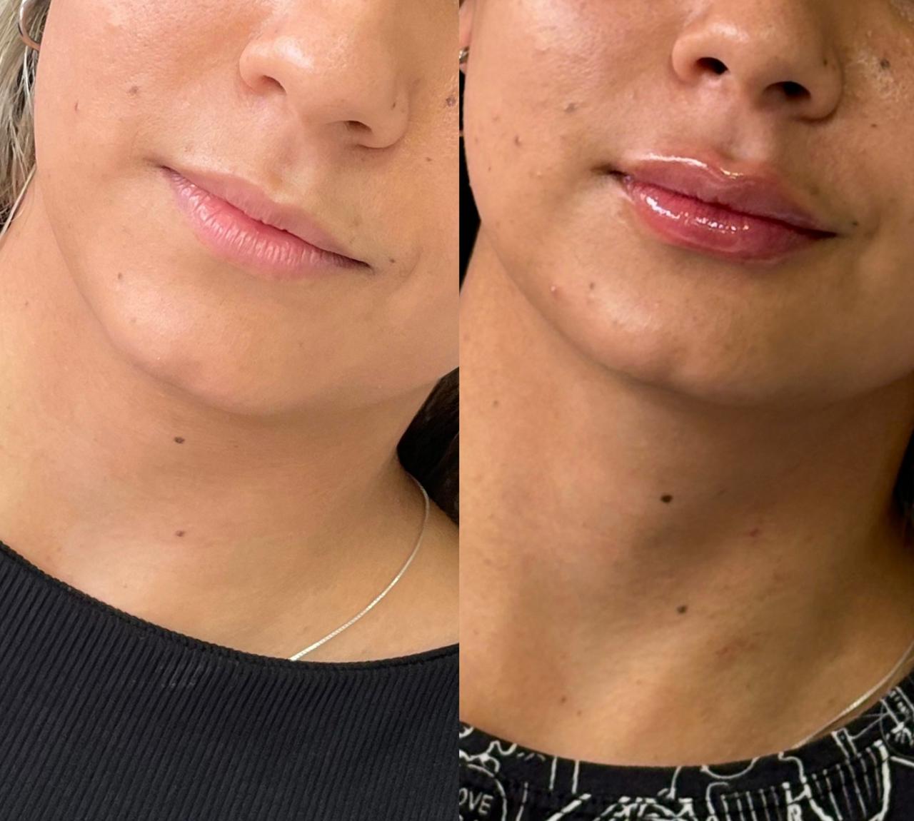 Antes e depois de preenchimento labial com foco em simetria